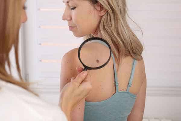 What Are Traditional Skin Lesion Removal Methods Herne Bay?