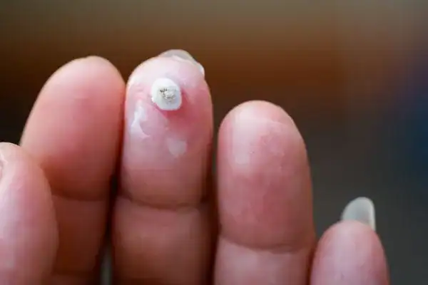 Image of white wart before cryopen treatment Herne Bay