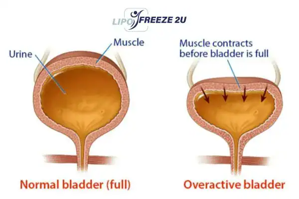 diagram of overactive bladder treatment Herne Bay