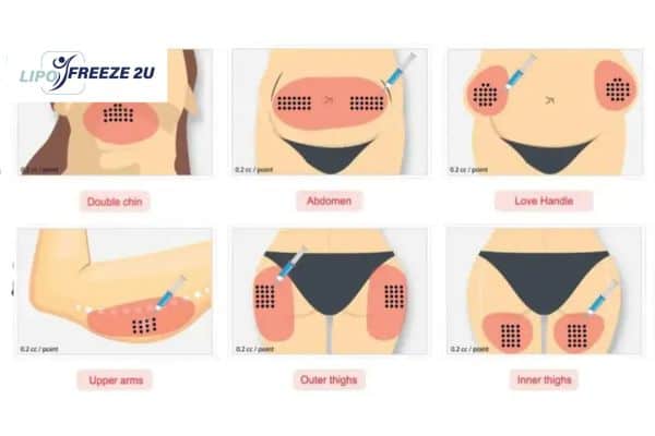 Benefits of Choosing Aqualyx for Fat Reduction Herne Bay