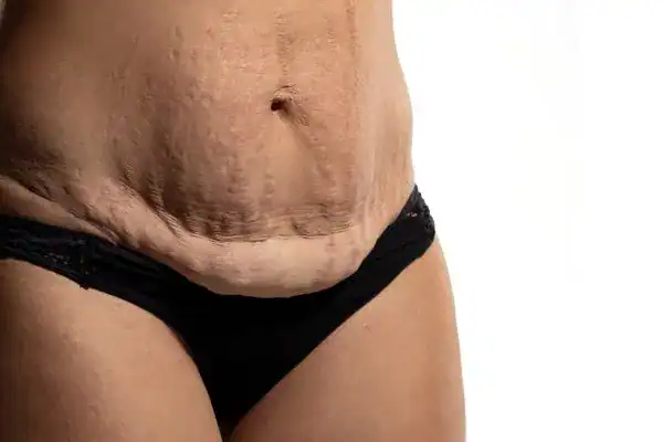 loose skin after weight loss injections Herne Bay