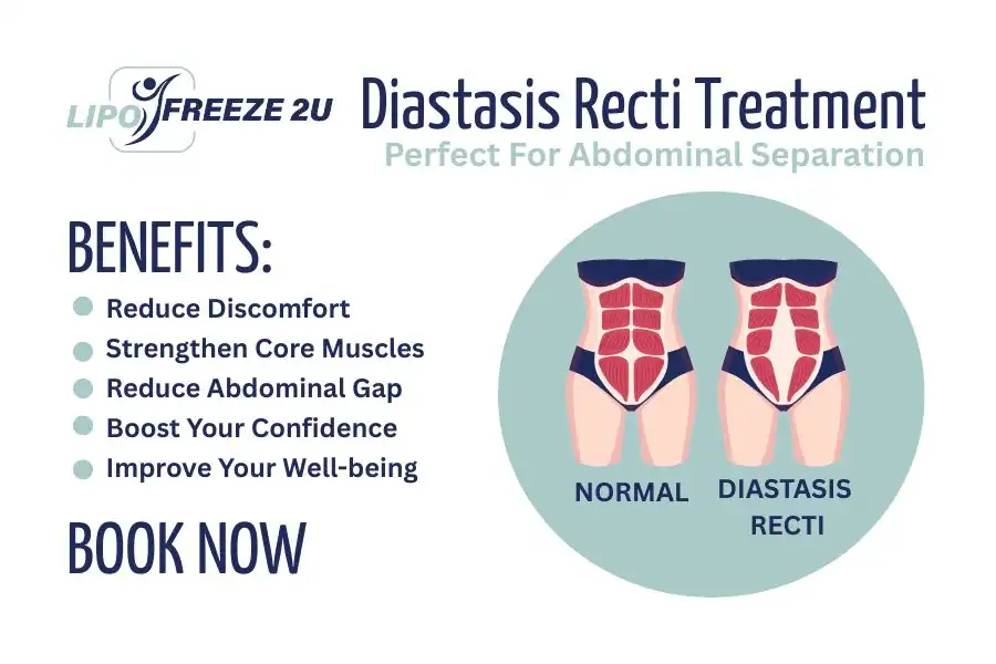 Benefits of body toning treatment Herne Bay for Diastasis recti