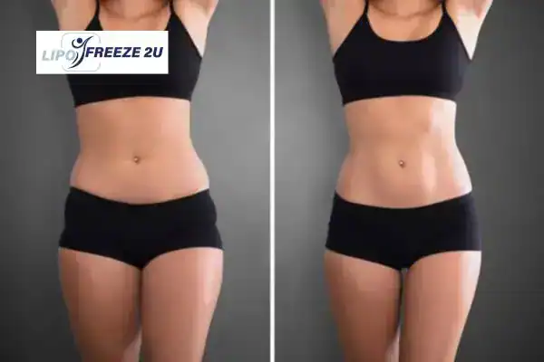 How Can LIPO FREEZE 2U Support Your Post-Pregnancy Body Recovery Herne Bay?