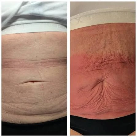 How Does RF Microneedling Improve Crepey, Thin and Uneven Skin Texture Herne Bay?