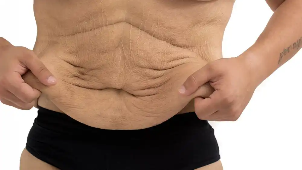 RF Microneedling for Loose Skin: How Can It Help Tighten and Reshape the Skin Herne Bay?